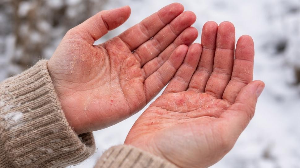 K���n �atlayan ellerin �aresi bu k�rde! 1 ka��kta eller pamuk gibi oluyor