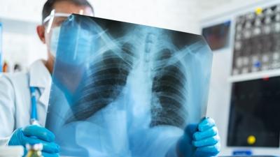 Verem geri mi d�n�yor? Uzman�ndan �nemli uyar�lar