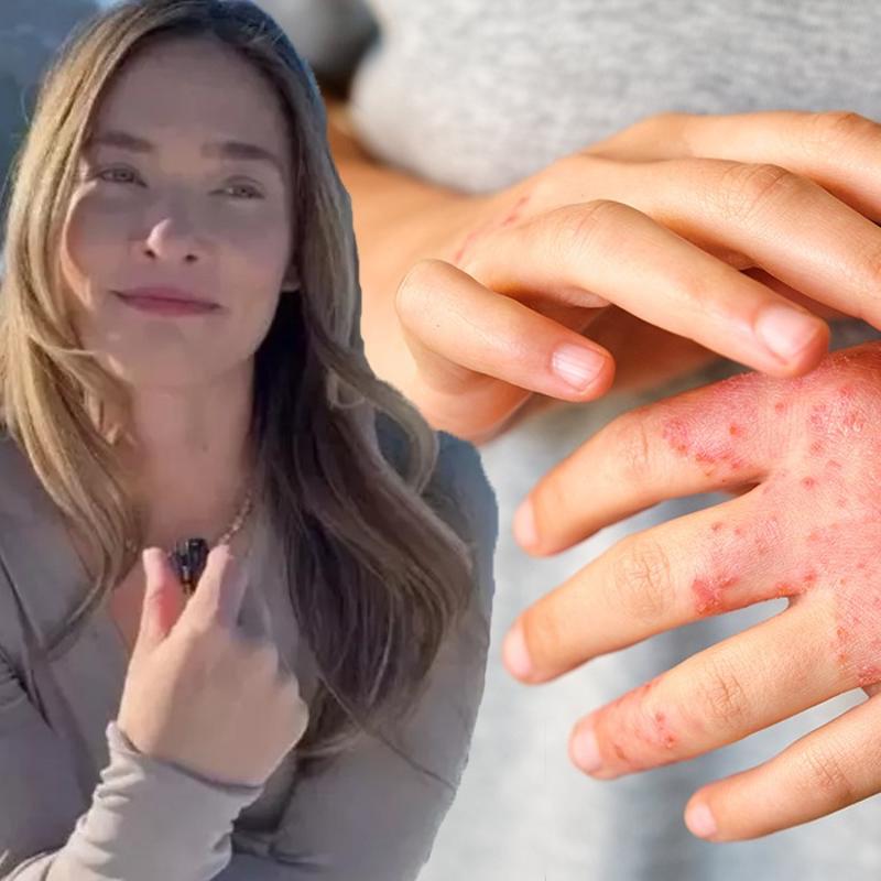 M�ge Boz,  20 y�ld�r m�cadele ediyorum  dedi! Sedef hastal��� bula��c� m�? ��te sedef belirtileri