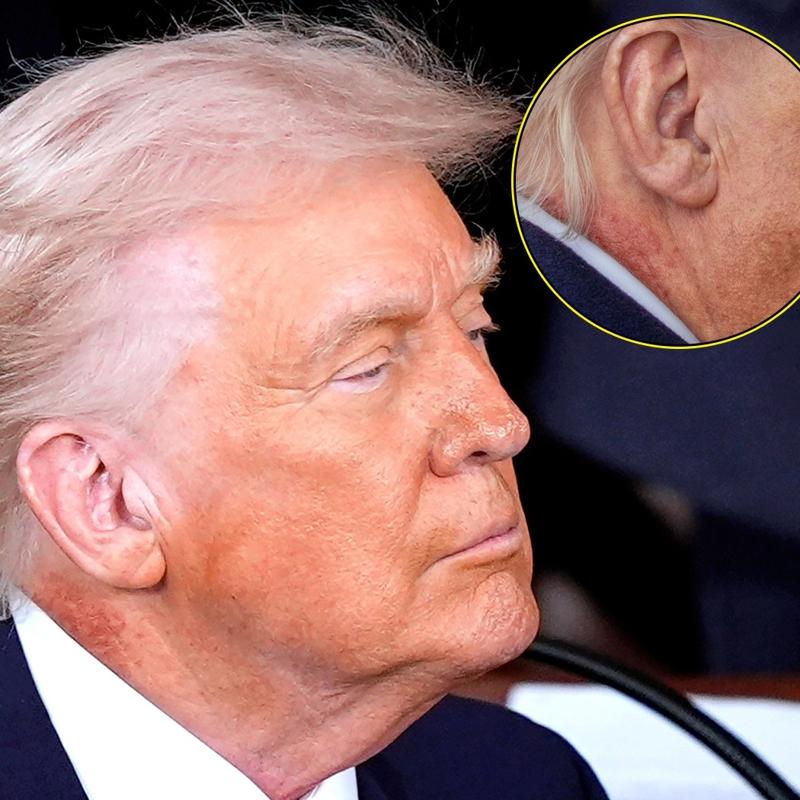 Boynundaki k�zar�kl�k dikkat �ekti... Trump'�n sa�l�k durumu hakk�nda a��klama