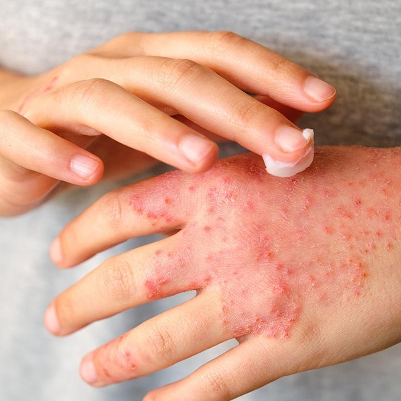 Cilde iyi geliyor san�l�yordu! Me�er egzama yap�yor, pullanmay� �o�alt�yormu�