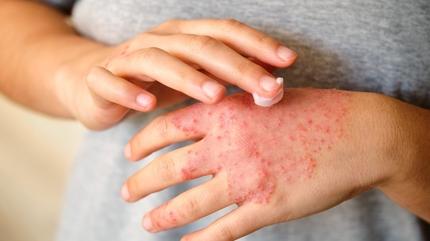 Cilde iyi geliyor san�l�yordu! Me�er egzama yap�yor, pullanmay� �o�alt�yormu�