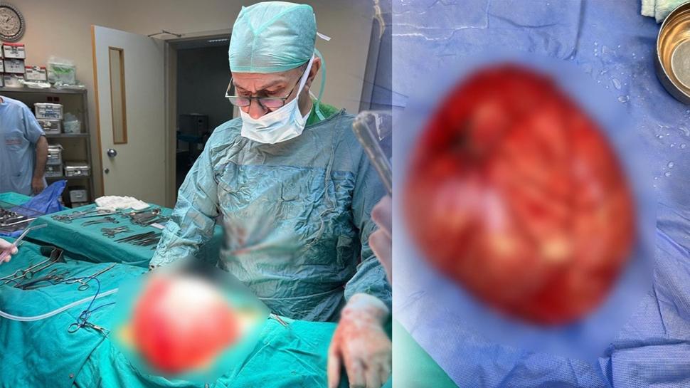 Kilo vermek için doktora gitmişti: Çocuktan 3,5 kiloluk kist çıktı
