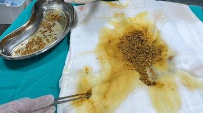 Doktorlar g�zlerine inanamad�! Bing�l'de t�p d�nyas�n� �a��rtan vaka