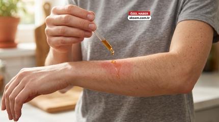 Yan�klara iyi gelen 3 ya�! Dermatoloji uzman� a��klad�