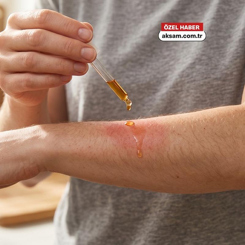 Yan�klara iyi gelen 3 ya�! Dermatoloji uzman� a��klad�