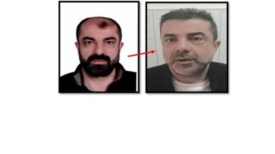 Ameliyatla karde�inin y�z�n� ald�! T�rkiye'ye s�z�nca yakay� ele verdi