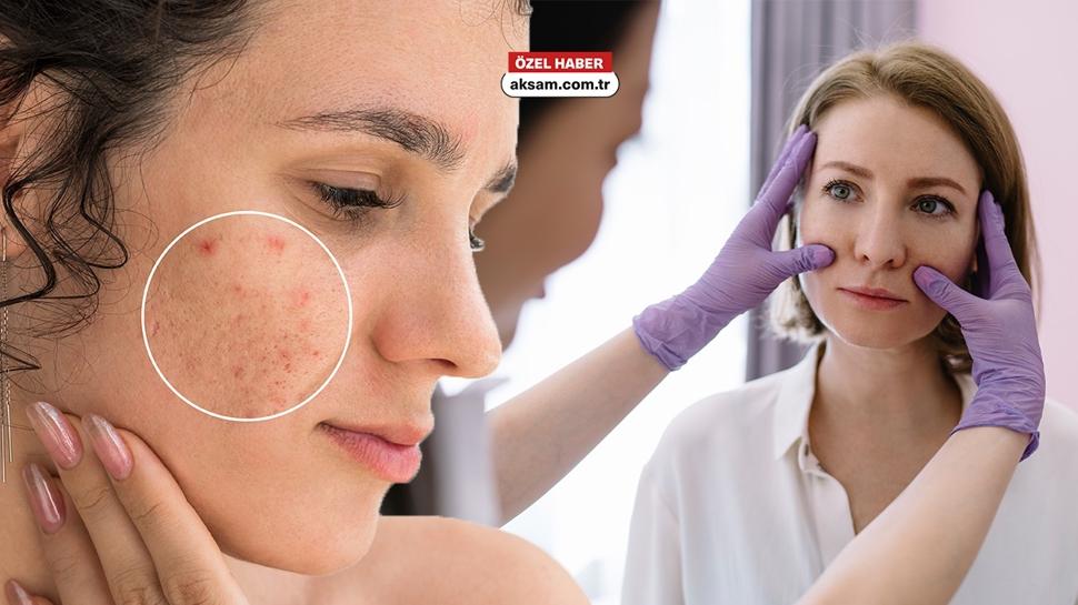 Cilt lekesi çıkar mı? Uzmanı açıkladı