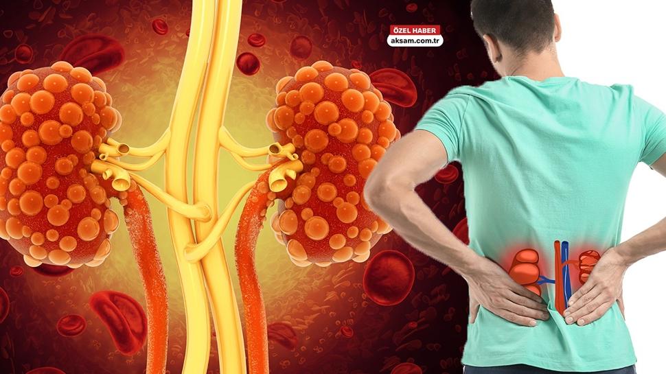 Kronik böbrek hastalığı risk gruplarında kimler var? Nefroloji Uzmanı testleri açıkladı