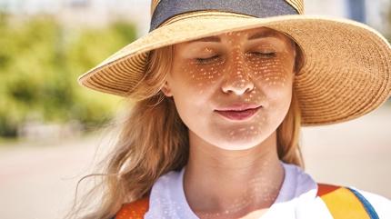 G�ne� lekesi tedavisi her d�nemde yap�l�r m�? Uzman� a��klad�