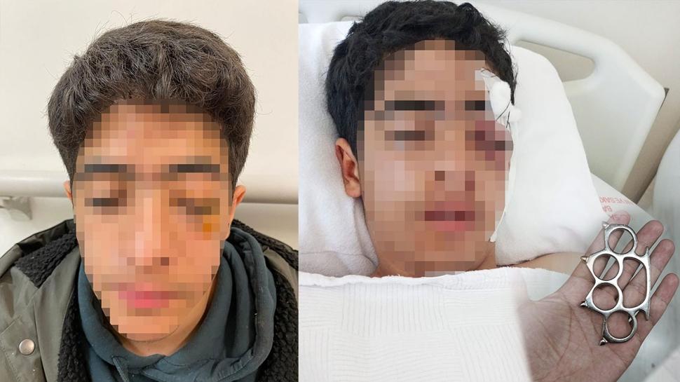 Zorbalığın böylesi görülmedi: Arkadaşına şaka yapma dedi.. Yüzü parçalandı