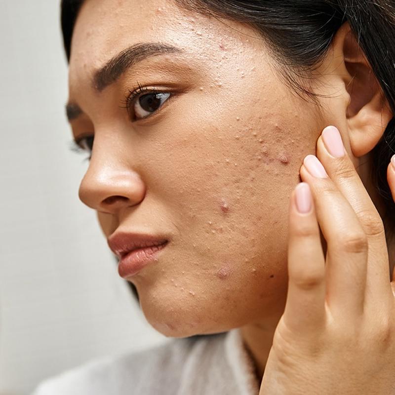 30'lu ya�larda sivilce k�busu! Hormonal akneyle sava�man�n yollar�