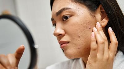 30'lu ya�larda sivilce k�busu! Hormonal akneyle sava�man�n yollar�