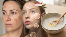 Y�zdeki g�ne� lekelerine yeni �neri: Pirin� suyu! Buzdolab�nda saklay�n, her gece s�r�n