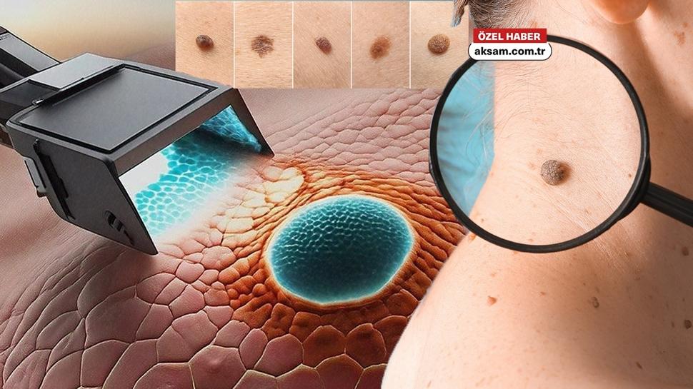 Benlerin renk değişimi cilt kanseri belirtisi olabilir! İşte kendini test etmenin yöntemi
