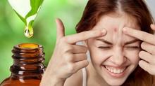 Sivilceyi s�kmak b�y�k hata! Gece �zerine sadece 1 damla s�r�n, sabaha kurutulmu� olarak uyan�n