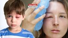 Dikkat! Ar� alerjisi �ld�rebilir! ��te �ocuklar ve yeti�kinler aras�ndaki farklar