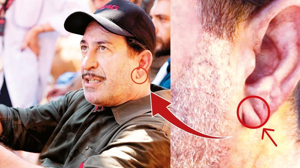 ‘Frank işareti' tartışması! Kalp krizi belirtisi olabilir mi?
