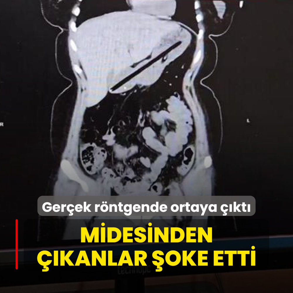 Midesinden kanlar akna evirdi! Gerek rntgende ortaya kt