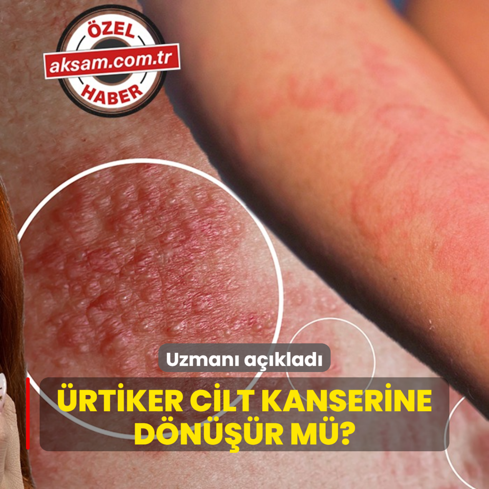 rtiker cilt kanserine dnr m? Uzman aklad: Kantyla balyor! Dudakta, gzde ve boazda ilik yapyor