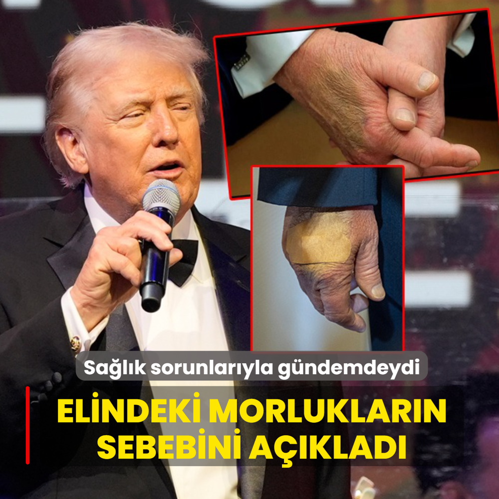 Sa�l�k sorunlar�yla g�ndemdeydi... Elindeki morluklar�n sebebini a��klad�
