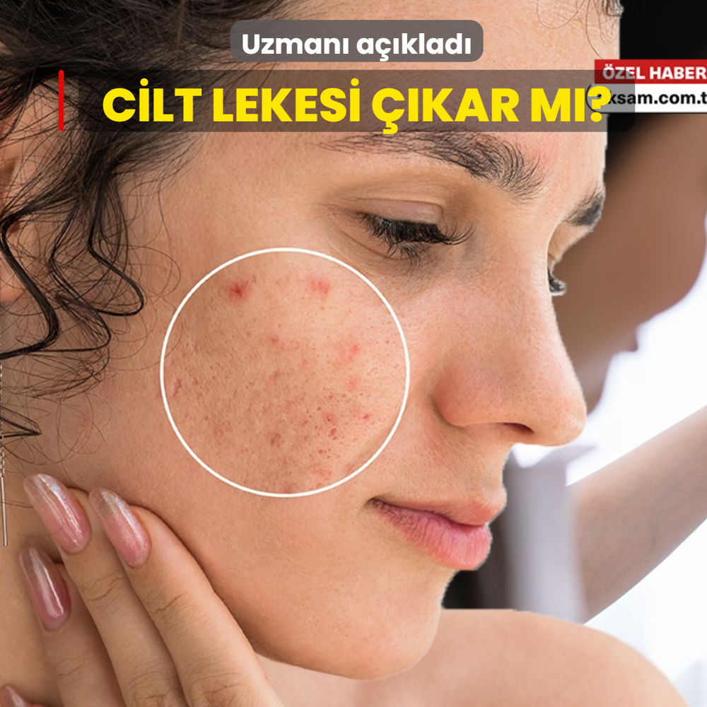 Cilt lekesi ��kar m�? Uzman� a��klad�
