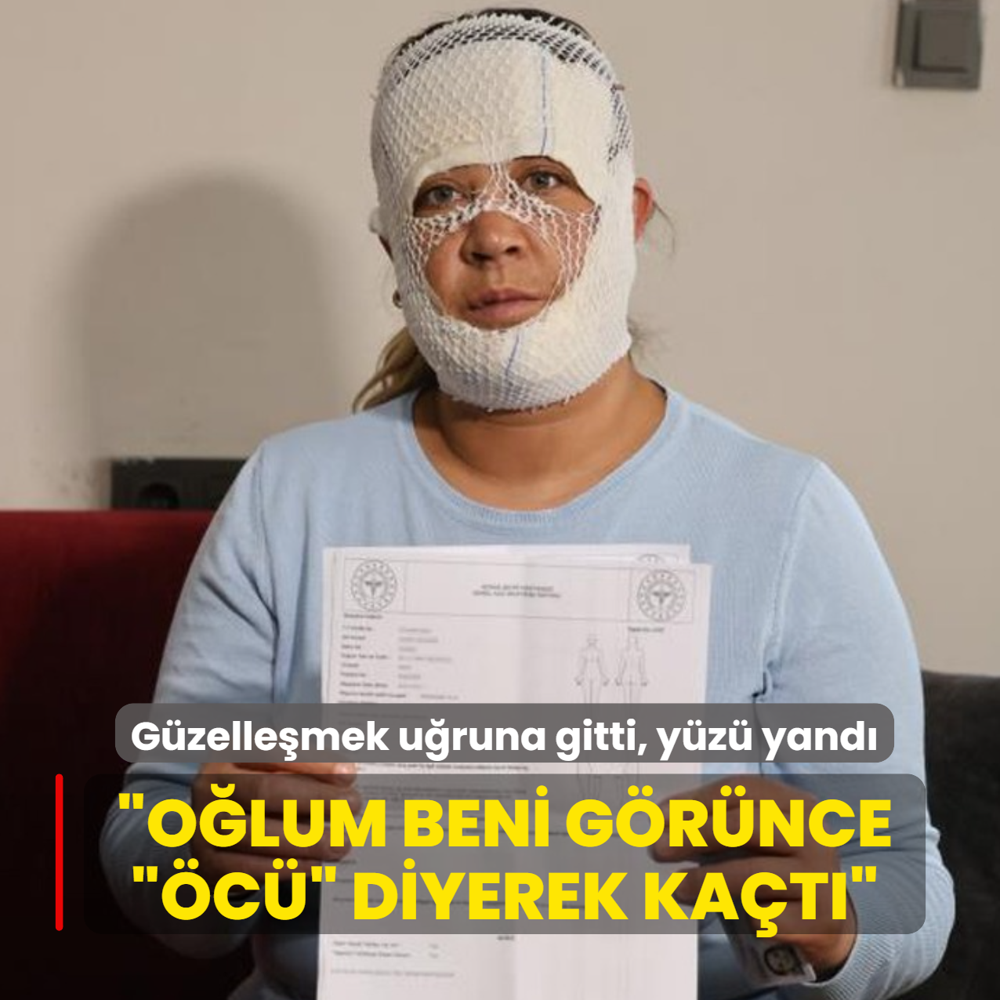 G�zelle�mek u�runa gitti, y�z� yand�: O�lum beni g�r�nce ��c�� diyerek ka�t�