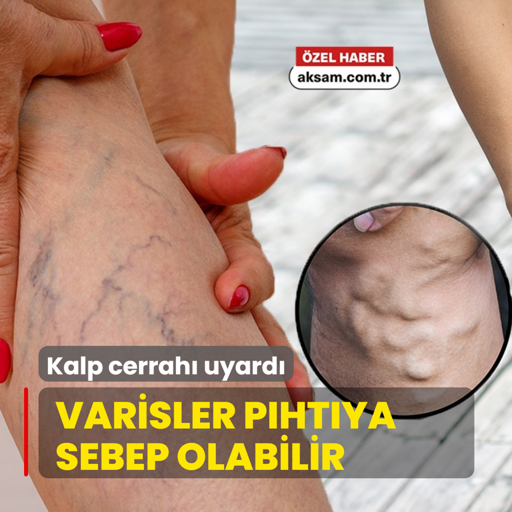 Kalp cerrah� uyard�: Varis tedavi edilmezse p�ht� atabilir, �l�m riski olabilir