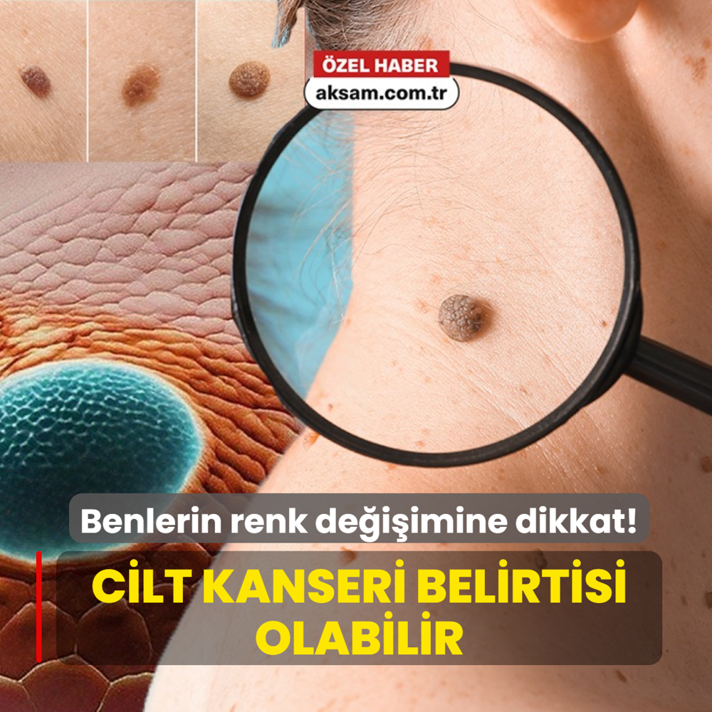 Benlerin renk de�i�imi cilt kanseri belirtisi olabilir! ��te kendini test etmenin y�ntemi