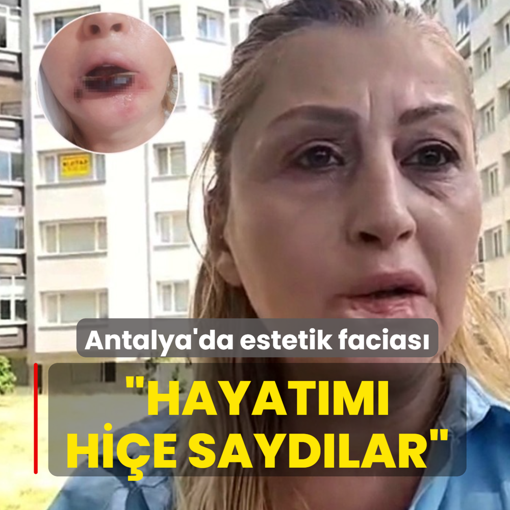 Antalya'da estetik facias�: Hayat�m� hi�e sayd�lar