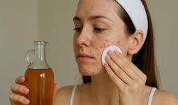 Sirkeyle sivilceleri temizleme yöntemi! Gerçekten işe yarıyor mu?