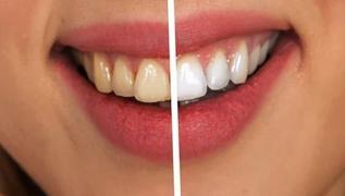 Sararan dişlere beyazlatma yöntemleri!  Diş beyazlatma yöntemleri