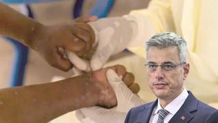 Bakan Memiolu'ndan maymun iei aklamas: Pandemi ihtimali yok'