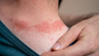 Bu kuma trn giyenin cildi yand! te dermatologlarn nerisi