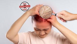 Uzman isimden egzama iin altn neri! te egzamay sfrlayan Omega-3 listesi