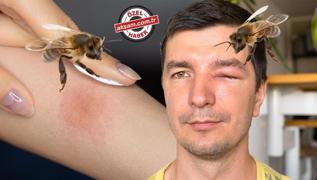 Ar sokmas deyip gemeyin: ldrebilir! Uzman uyard: En byk tehlike anafilaksi