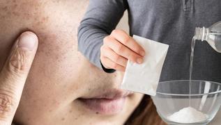 Patlcan moru cilt lekelerine bn-i Sina losyonu: Sirkeyle kartrn, srn