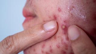 Beyaz sivilceleri 15 gnde kurutuyor! Kremlere son, iltihapl sivilcelerden kurtaryor