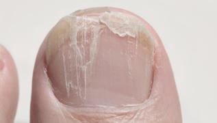 Trnak krlnca parmaklar iyiletiren doal kr: Ne ar ne sz kalyor