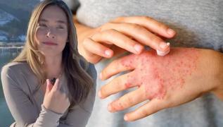 M�ge Boz, �20 y�ld�r m�cadele ediyorum� dedi! Sedef hastal��� bula��c� m�? ��te sedef belirtileri