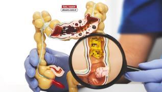 Kolon kanseri i�in bu tipler risk alt�nda! Uzman� a��klad�