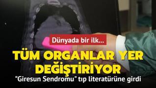 Dnyada bir ilk... Giresun Sendromu tp literatrne girdi: Tm organlar yer deitiriyor