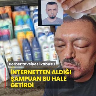 Berber tavsiyesi kabusu! nternetten ald ampuan bu hale getirdi