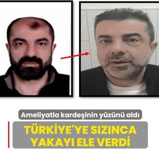 Ameliyatla karde�inin y�z�n� ald�! T�rkiye'ye s�z�nca yakay� ele verdi