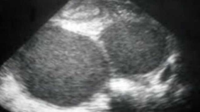 İsminin aksine kadınlara hayatı zehir eden kist Çikolata kisti